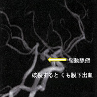 脳動脈瘤　破裂するとくも膜下出血（画像）